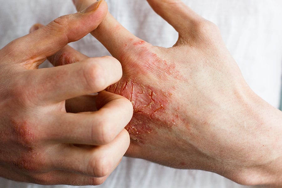 Gloves for Psoriasis on Hands