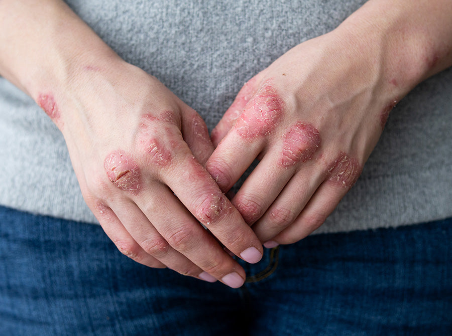 gloves to heal cracked hands