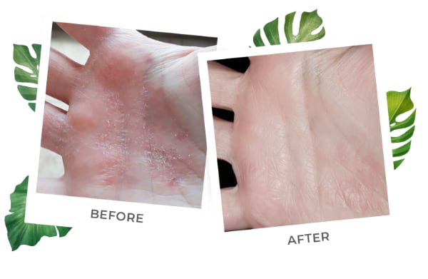 hand lotion for eczema before and after
