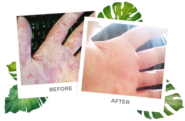 hand lotion for psoriasis