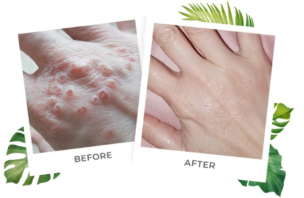 psoriasis relief lotion before and after